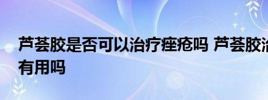 芦荟胶是否可以治疗痤疮吗 芦荟胶治疗痤疮有用吗 