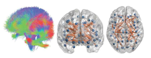 硬化症可以帮助新方法测量大脑患者多发性活动